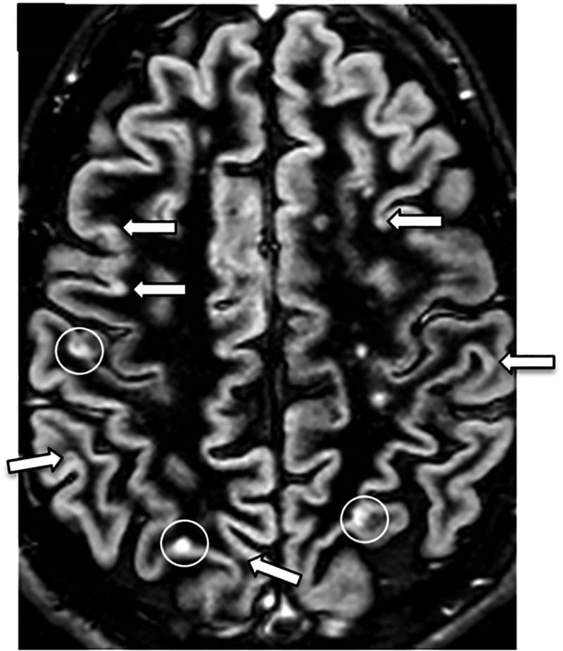 Axial brain MRI scan using a double inversion recovery sequence, with white circles marking cortical and juxtacortical lesions